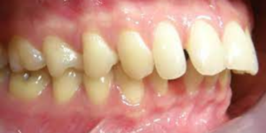Buck Teeth - Orthodontic treatment in Bangalore