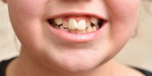 Crowding - Orthodontic treatment in Bangalore