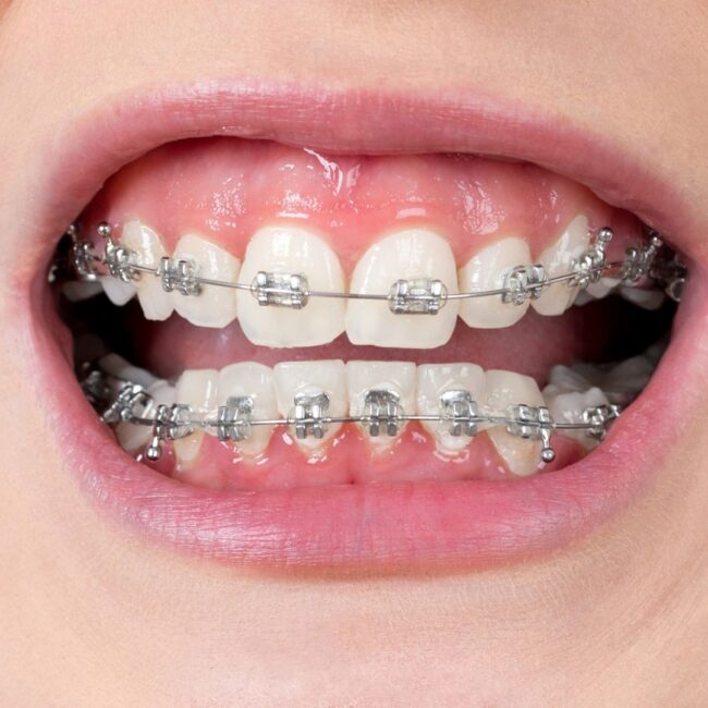 Orthodontist and Orthodontic Treatment - Childhood Smiles