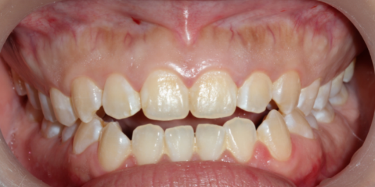 Open Bite - Orthodontic treatment in Bangalore