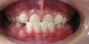 Underbite - Orthodontic treatment in Bangalore