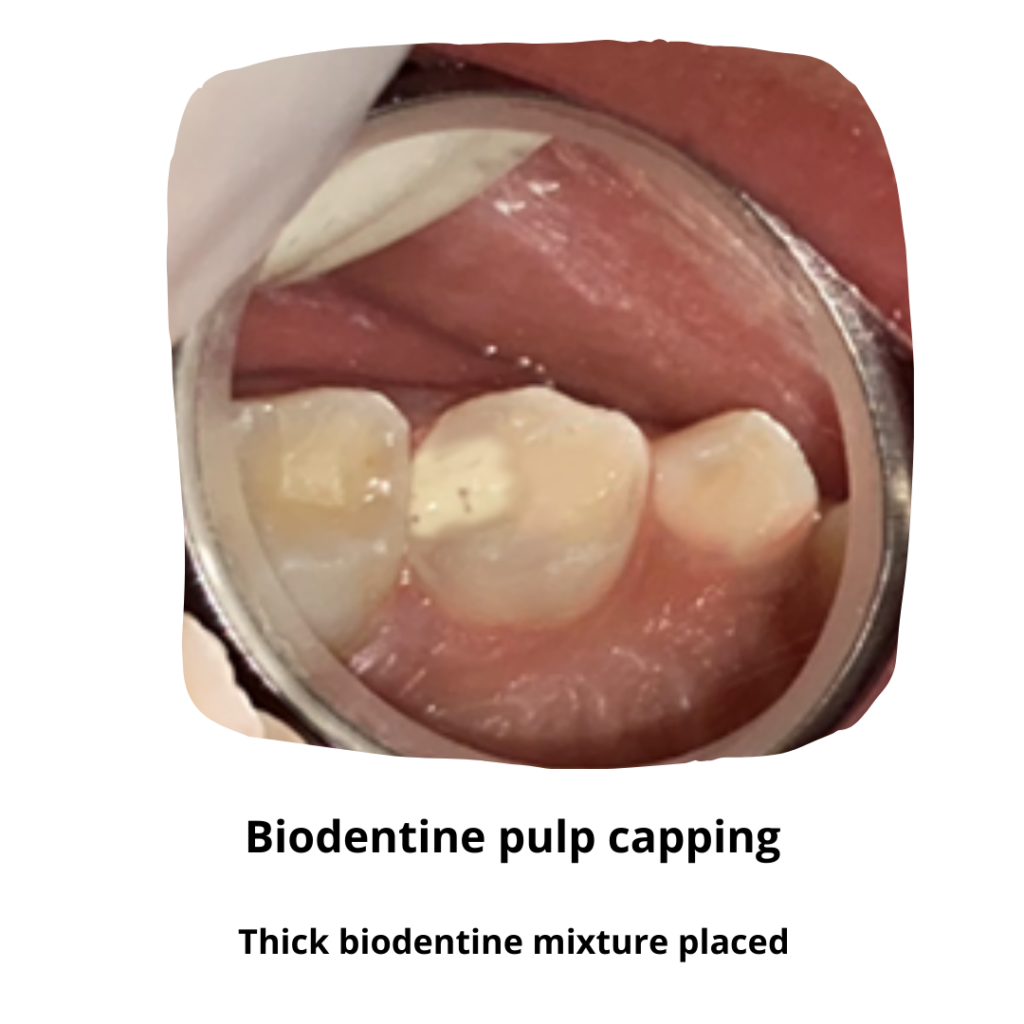 Biodentine filling for Root canal treatment