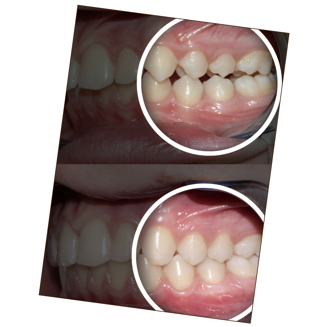 All About Clear Aligners and Invisible Braces Treatment in Bangalore. -  Childhood Smiles