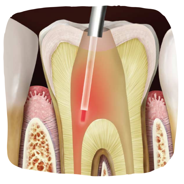 Root canal disinfection by laser treatment