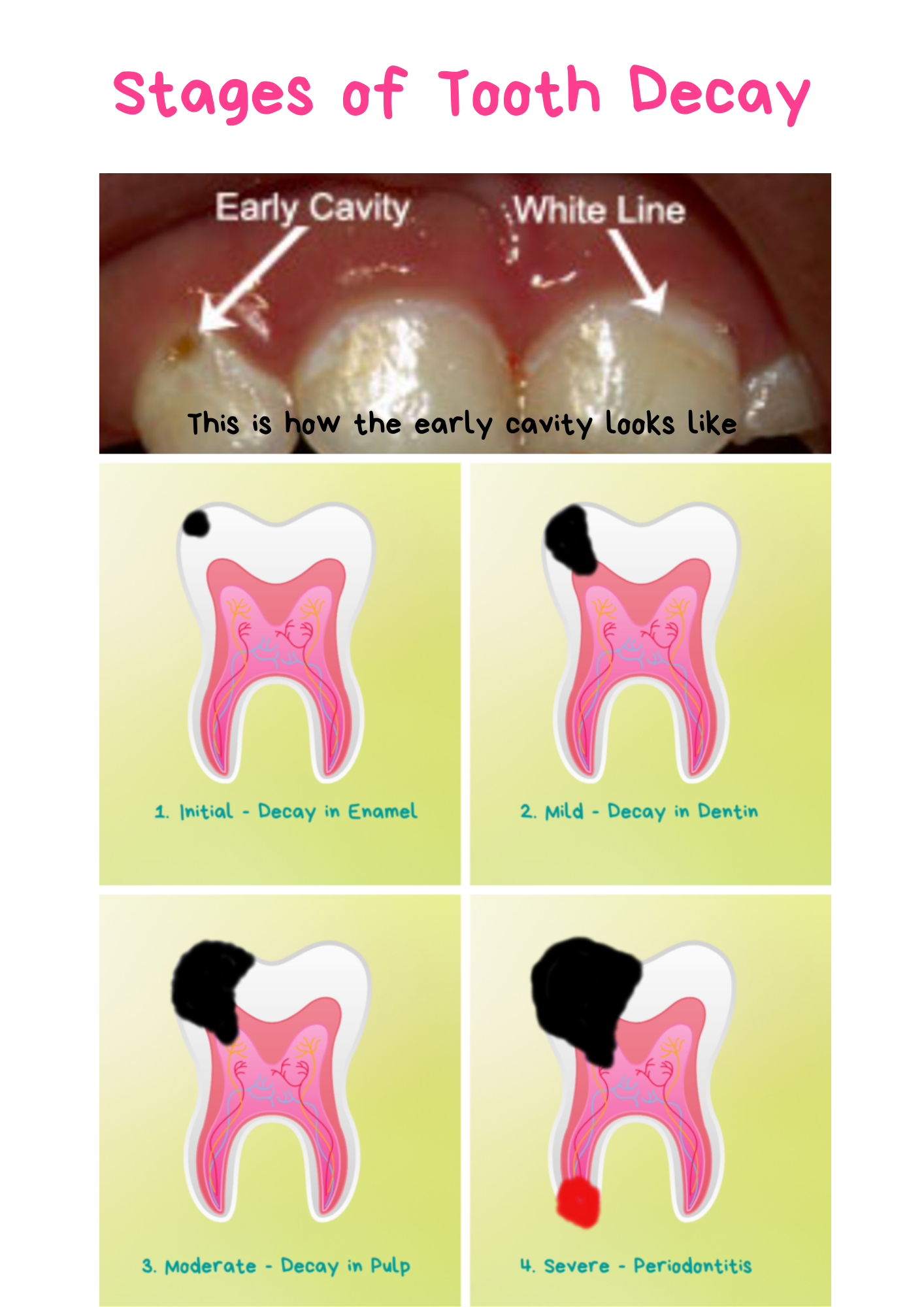 early stage cavity