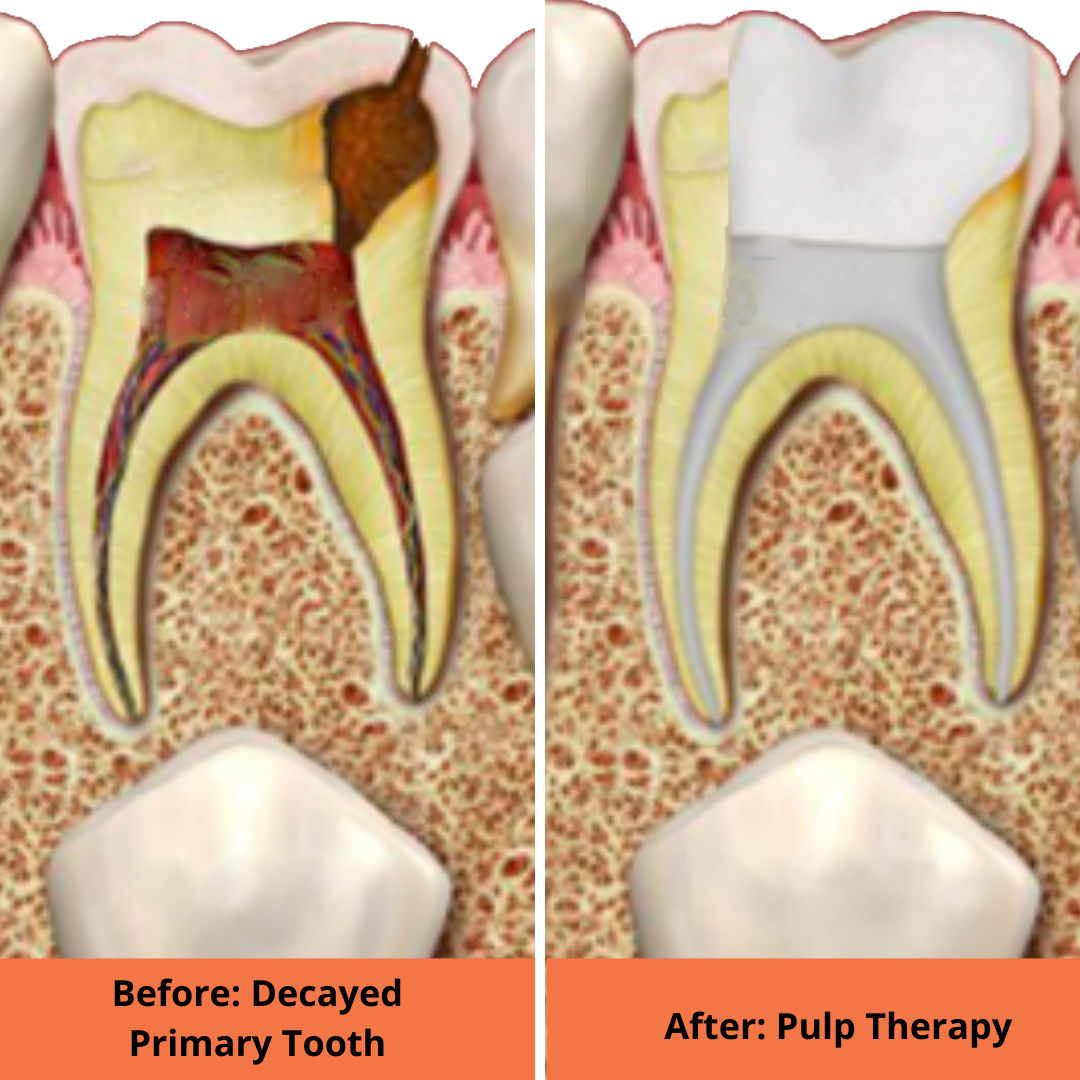 Root canal treatment before and after images