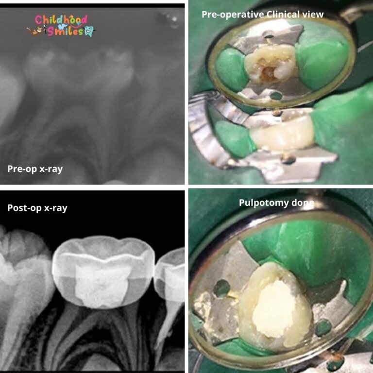 Pulpotomy (Kids root canal treatment) in Bangalore.