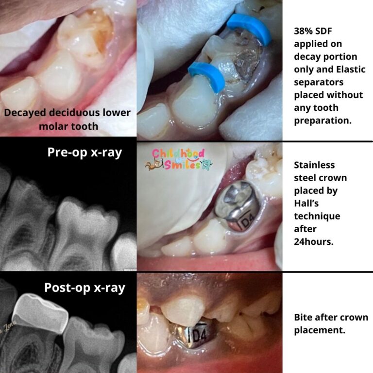 Dental treatment of child decayed teeth in bangalore..