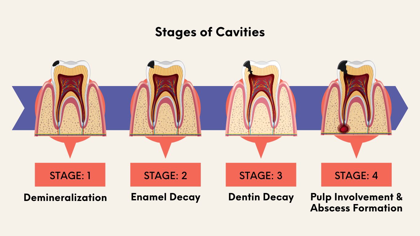Understanding 5 Cavity Stages A Comprehensive Guide YZITRQ Understanding 5 Cavity Stages A Comprehensive Guide YZITRQ
