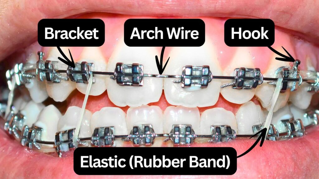 What are Teeth / Dental Braces?