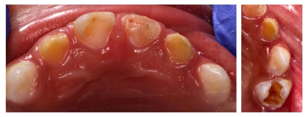 Early Childhood Caries (ECC) - a rapidly progressing form of tooth decay seen in infants and preschool children