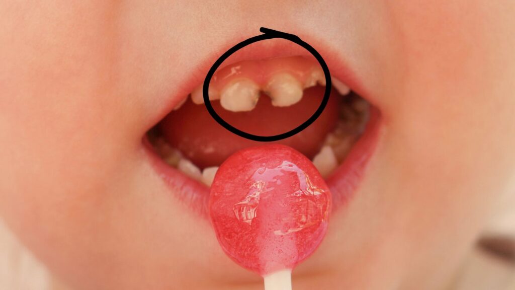Early childhood caries