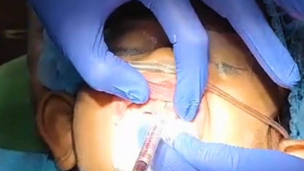 Early childhood caries treatment under IV sedation