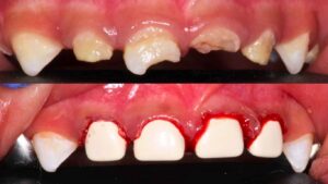 From Extensive Tooth Decay to a Confident Smile: Arjun’s Journey at Just 22 Months