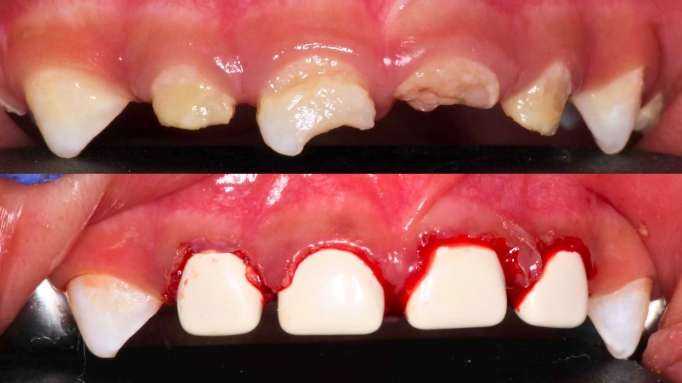 From Extensive Tooth Decay to a Confident Smile: Arjun’s Journey at Just 22 Months