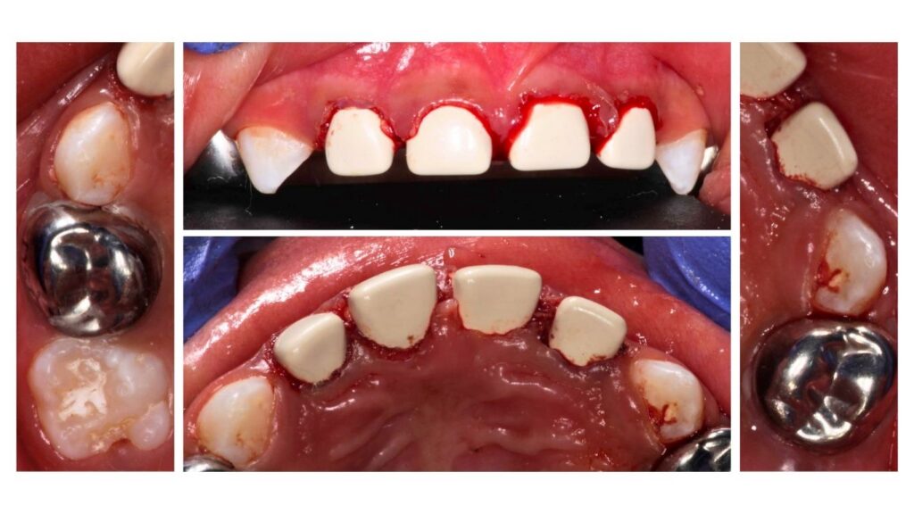 Restoring baby teeth from early childhood caries
