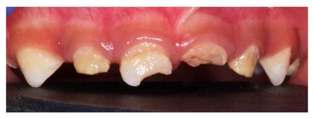 Two year old with severe early childhood caries