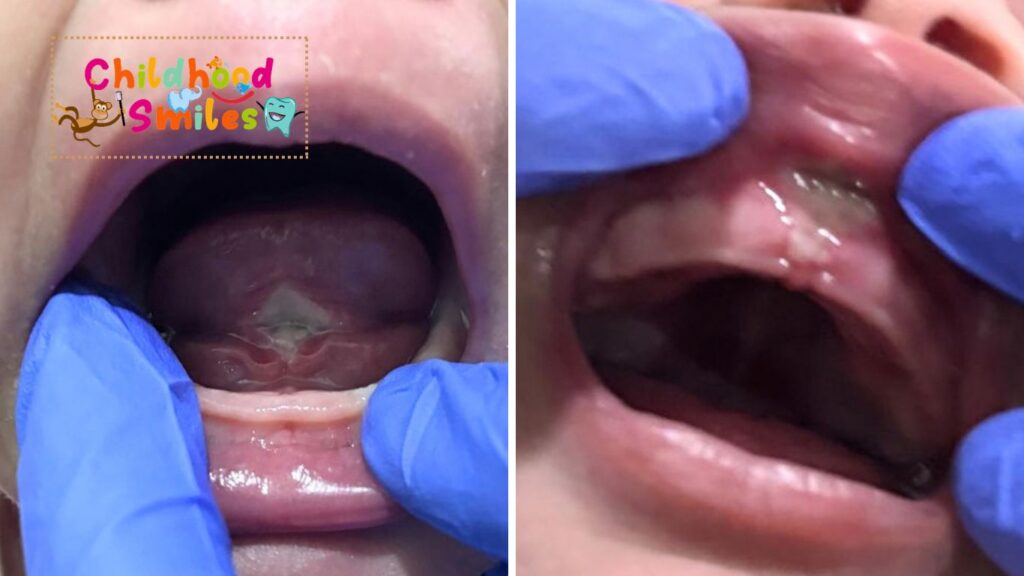 Tongue & Lip Tie Release - 3 days follow-up