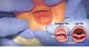 Tongue-Tie and Lip-Tie Treatment in Bangalore