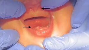 Tongue-Tie and Lip-Tie in a one month old child
